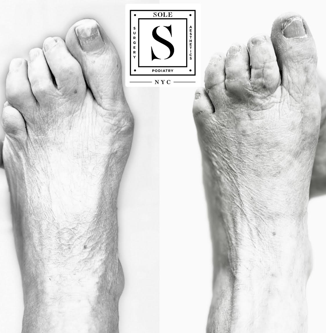 Bunion Before and After