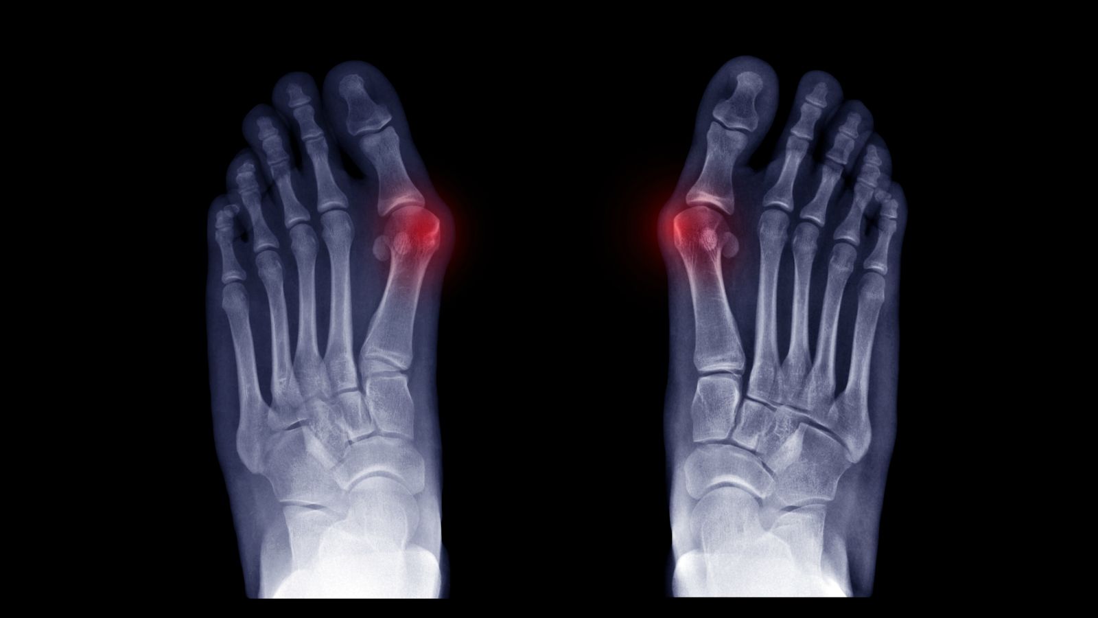 Bunions in an X-Ray