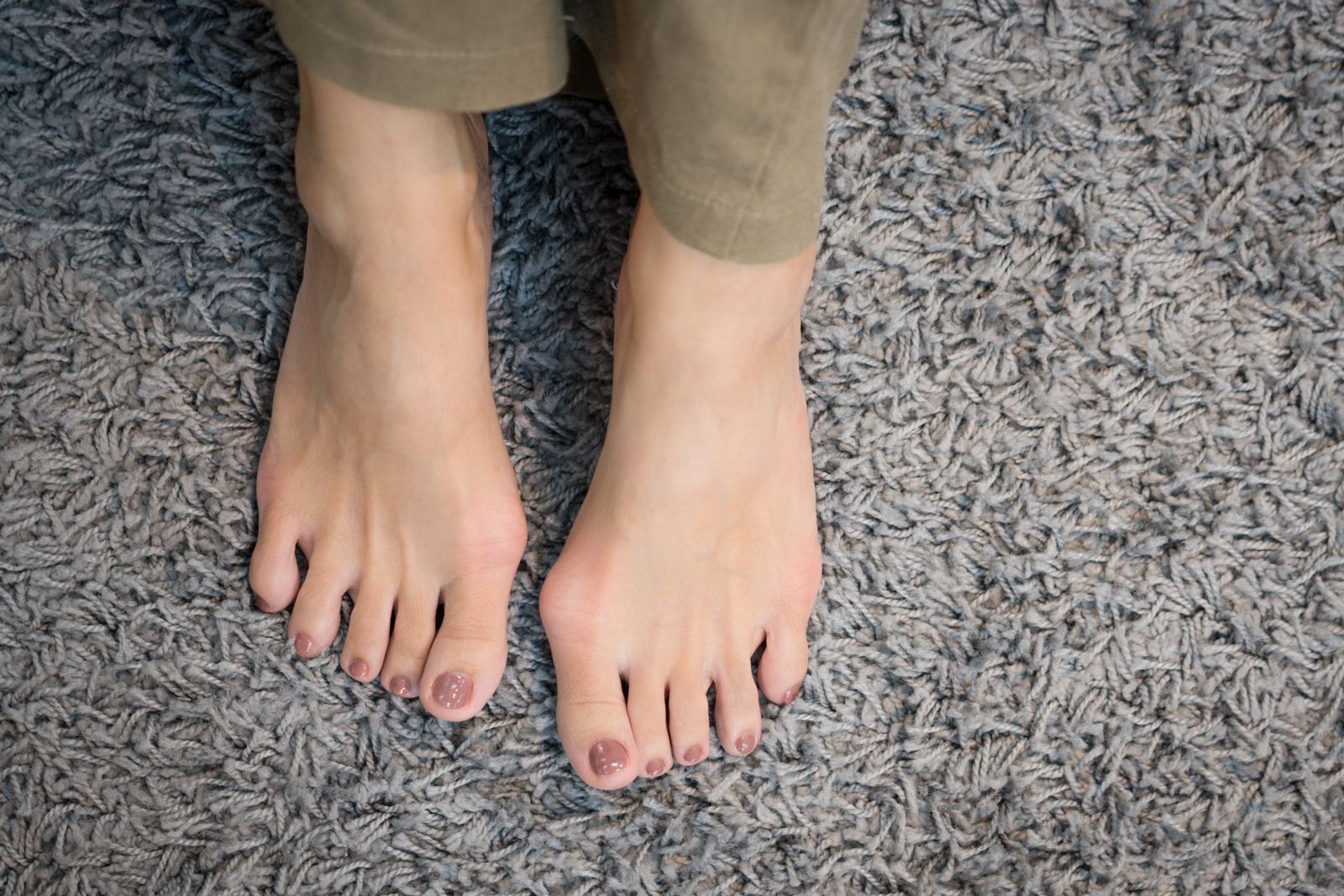 Feet With Bunions on Them
