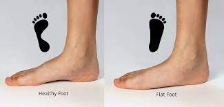 Flat foot vs. normal foot illustrated by our NYC podiatrist