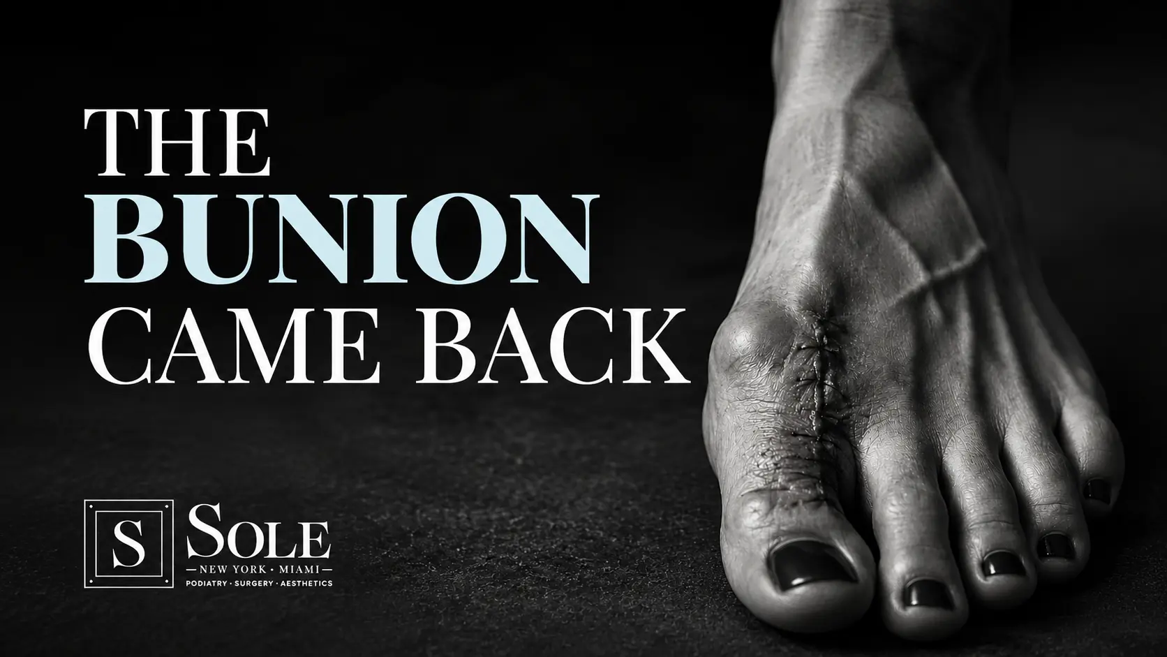 Can a Bunion Come Back After Surgery? Recurrent Bunion Treatment in NYC